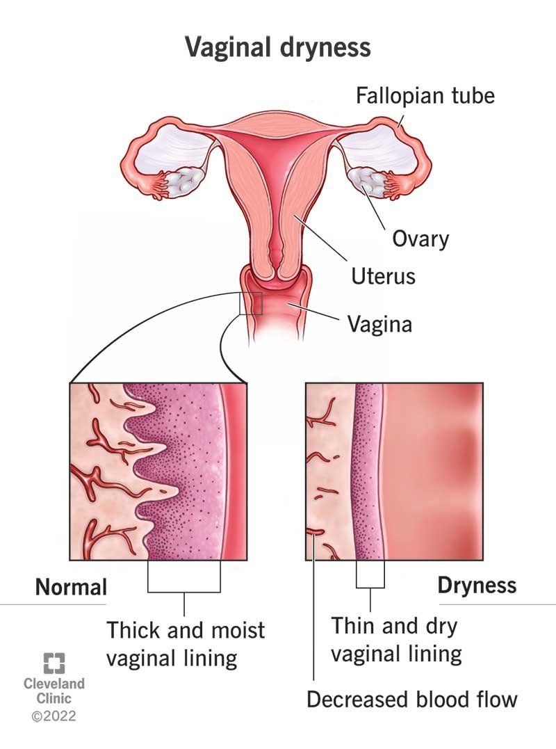 Is Vaginal Dryness a Sign of Pregnancy
