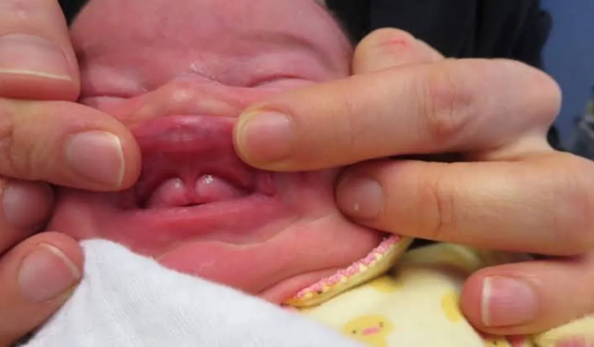 Signs of lip tie in newborn baby during breastfeeding